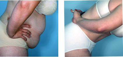 Tummy Tuck 4 before/after with Dr. Emile Picarella with Williamson Cosmetic Center in Baton Rouge