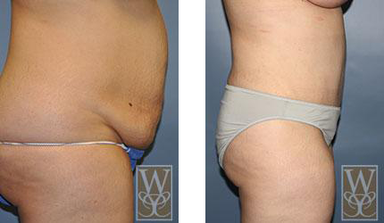 Tummy Tuck 3 before/after with Dr. Emile Picarella with Williamson Cosmetic Center in Baton Rouge