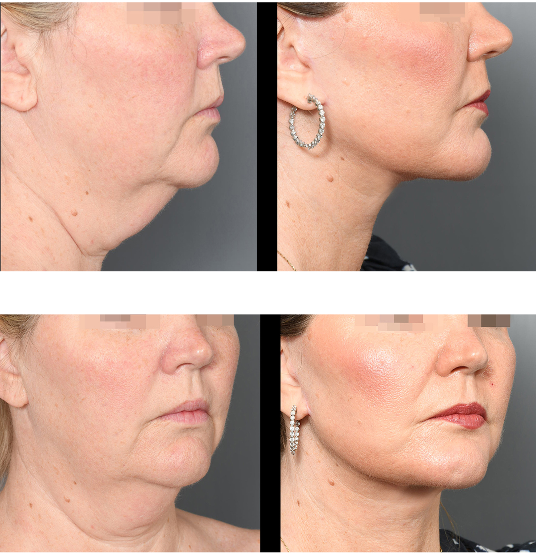 before and after facelift in baton rouge 