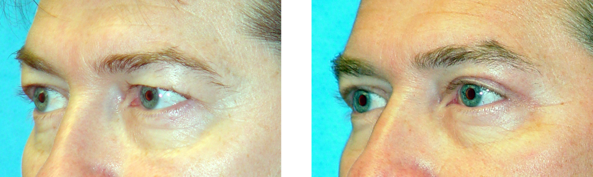 Comparison of eyes before and after an eyelid surgery.
