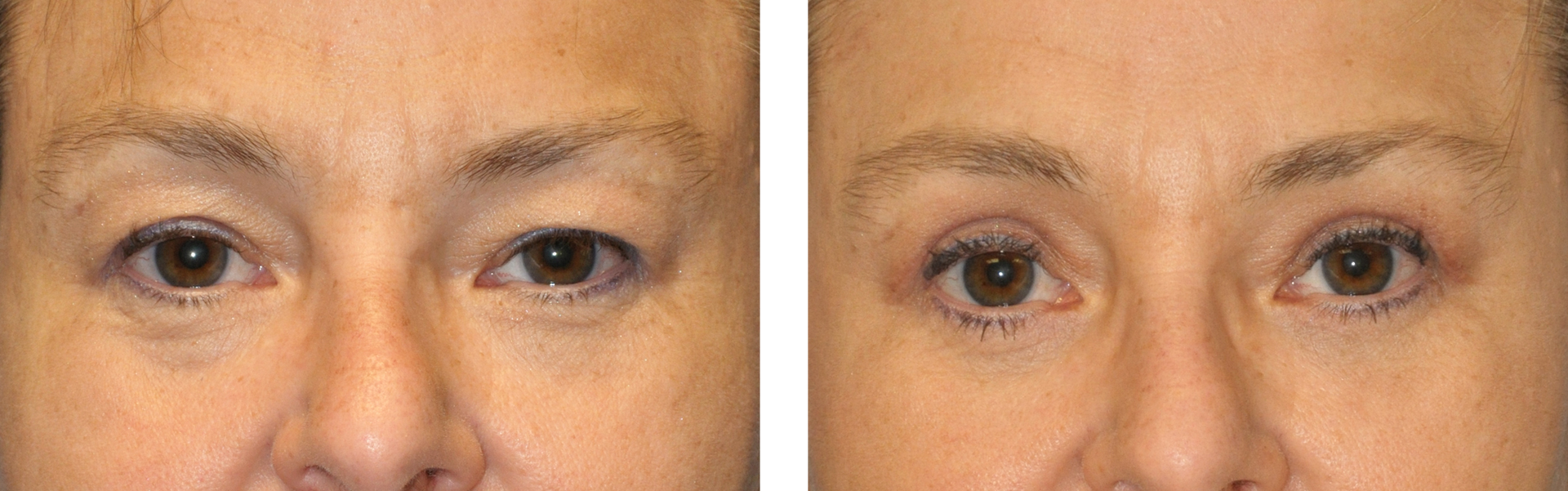 Before and after photos of eyelids, showing reduction in droopiness after treatment.