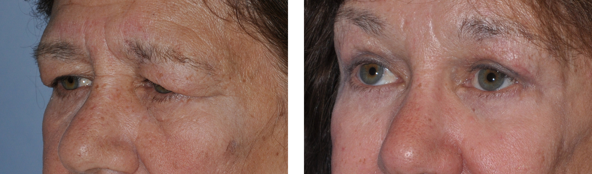 Williamson Cosmetic Center - upper bleph gallery
