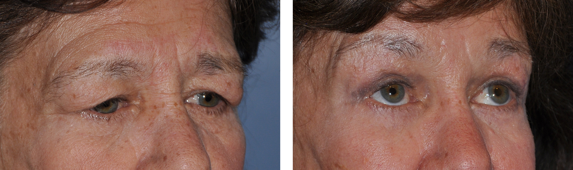 Before and after of eye lift procedure; droopy eyelid on left, lifted on right.