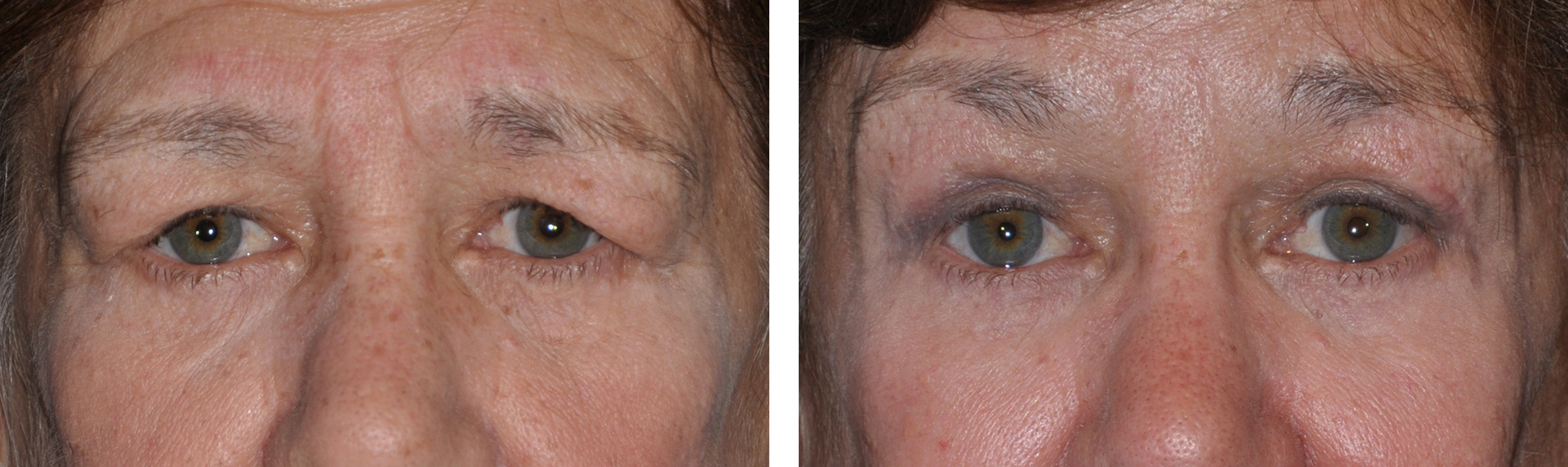 Close-up of a person's eyes before and after an eyelid lift. Eyes are green.
