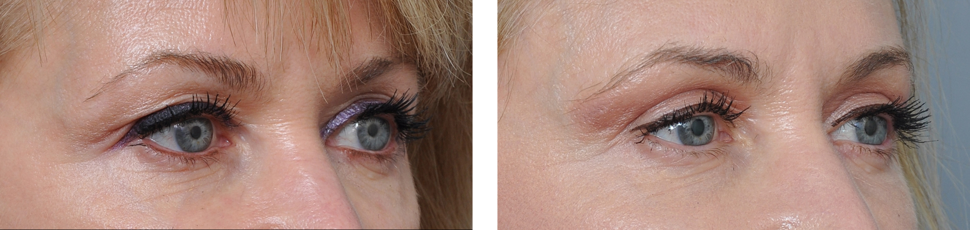 Two close-up photos of eyes. The first shows sagging eyelids, the second shows improved lift.
