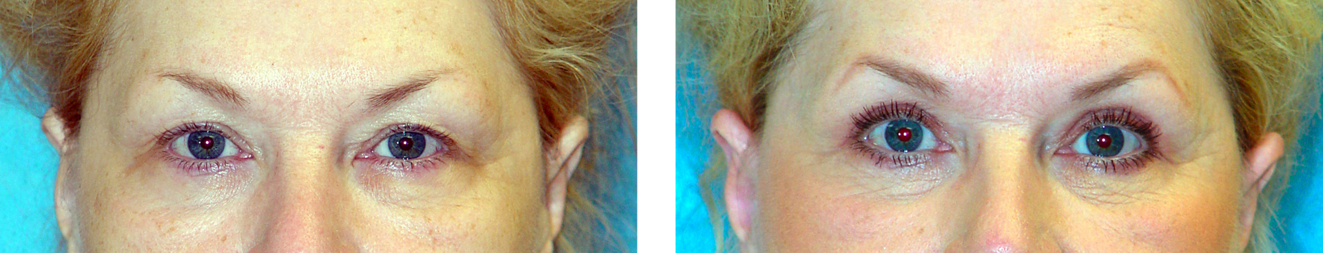 Comparison of eyes before and after a procedure, showing lifted eyelids.