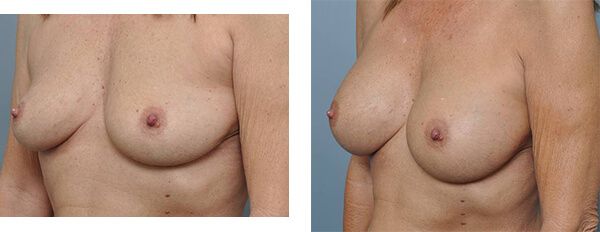 Before and after breast augmentation.