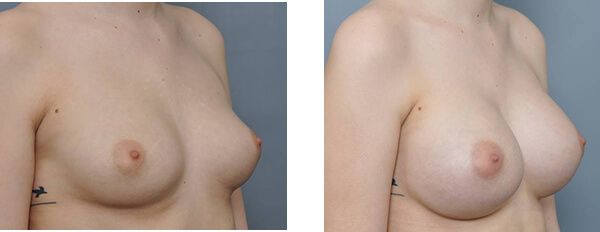 Breast augmentation comparison: before and after shots, skin tone, nipples visible.