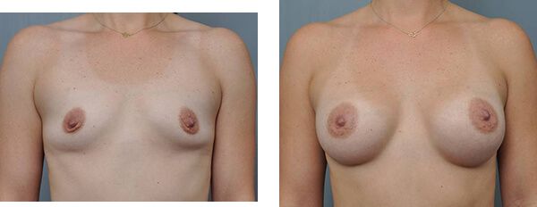 Breast augmentation before and after.