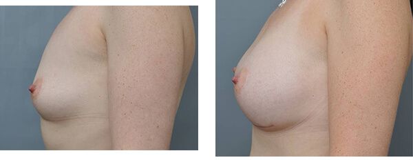Before and after photos of breast augmentation.