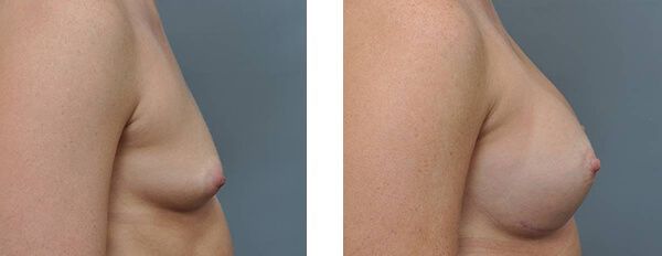 Comparison of side profiles of a person's chest before and after breast augmentation surgery.