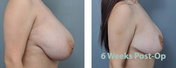 Comparison of breasts before and 6 weeks after surgery, side view.