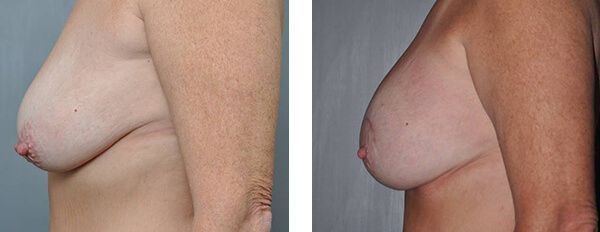 Before and after photos of breast augmentation.