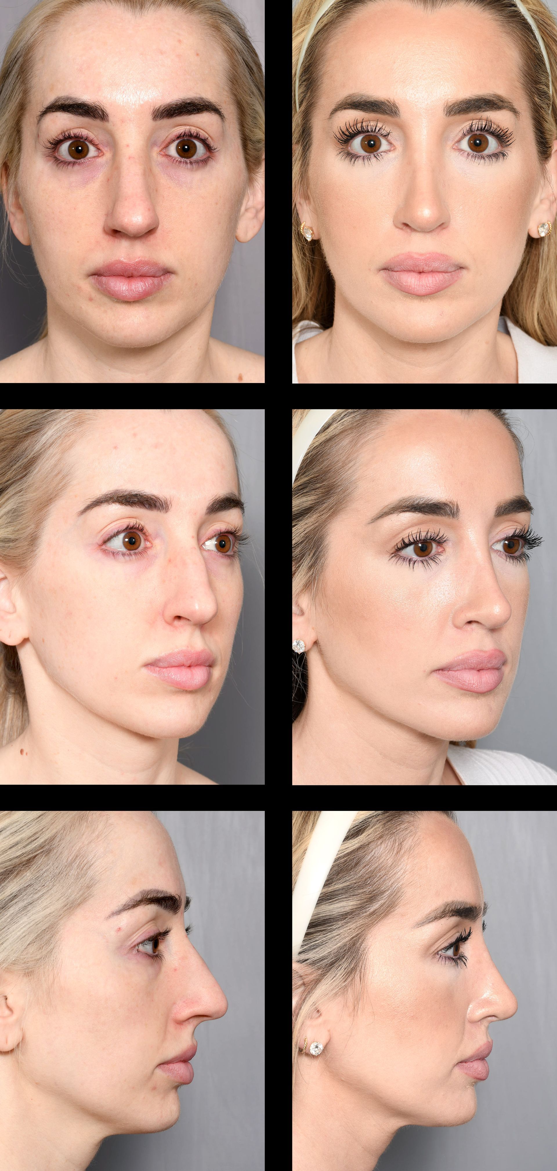 before and after rhinoplsty in baton rouge