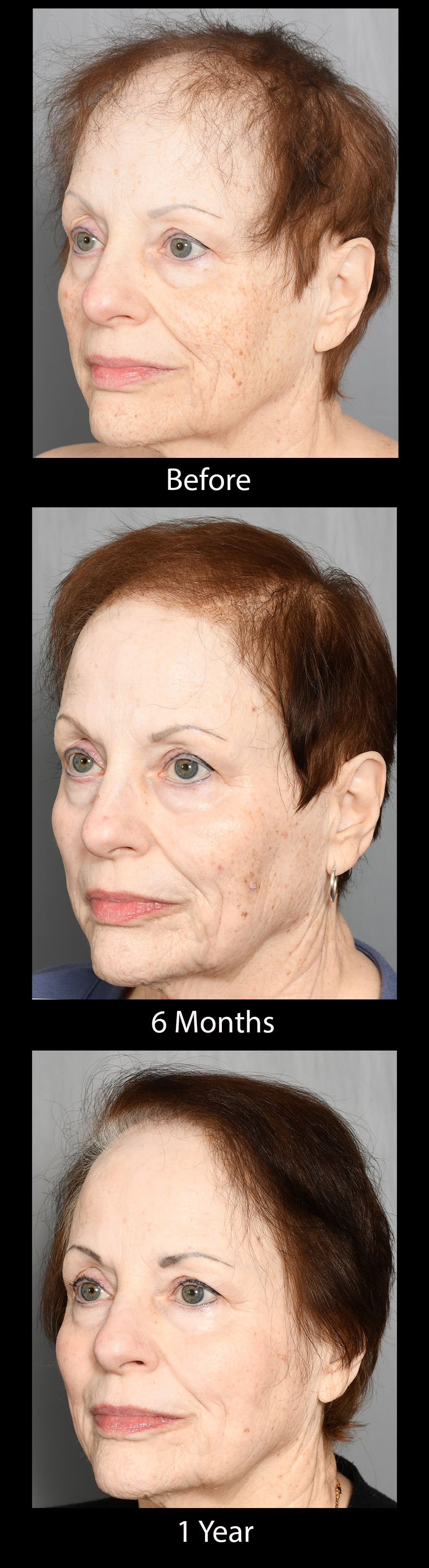 before and after hair restoration 