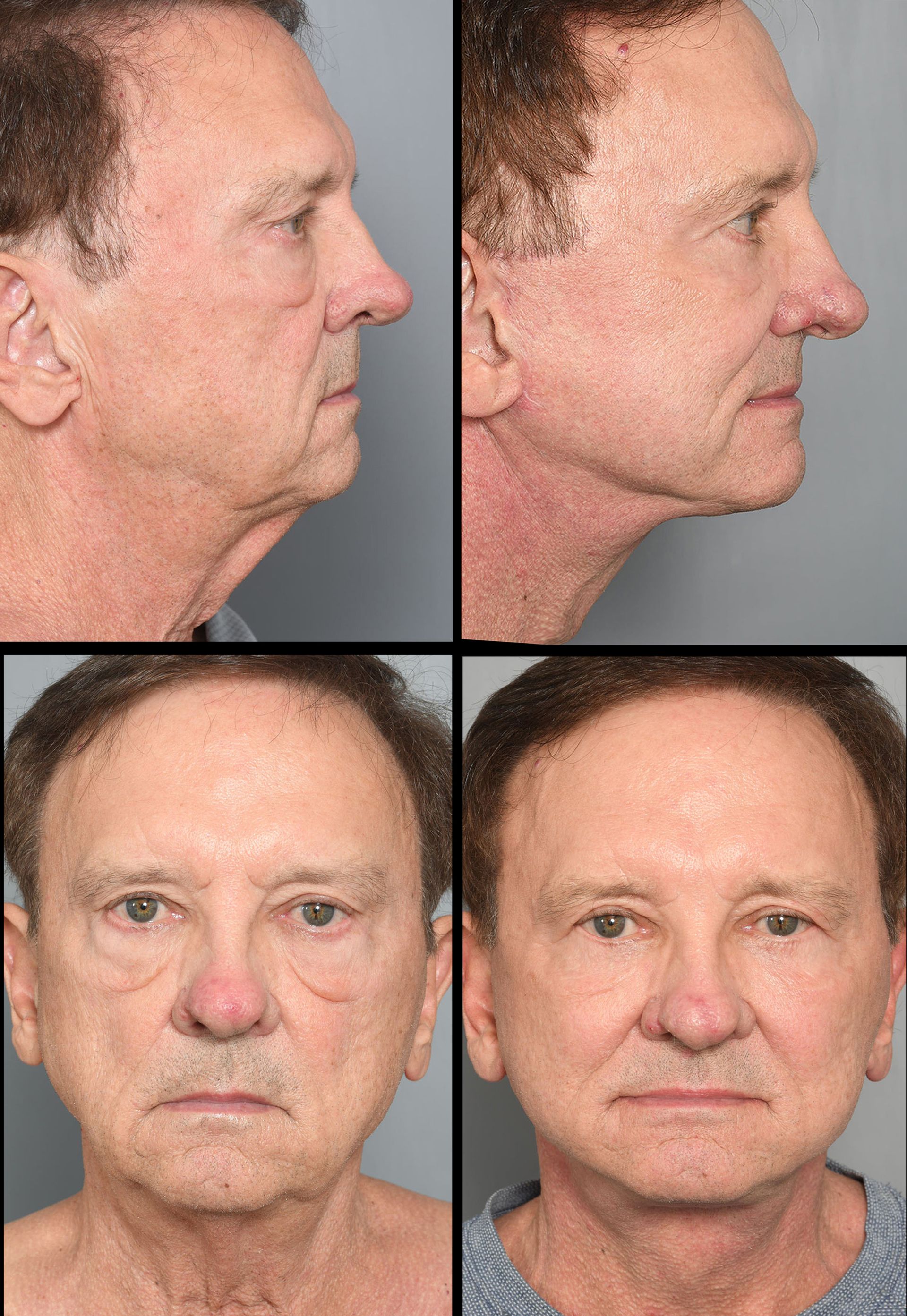 before and after facelift in baton rouge 