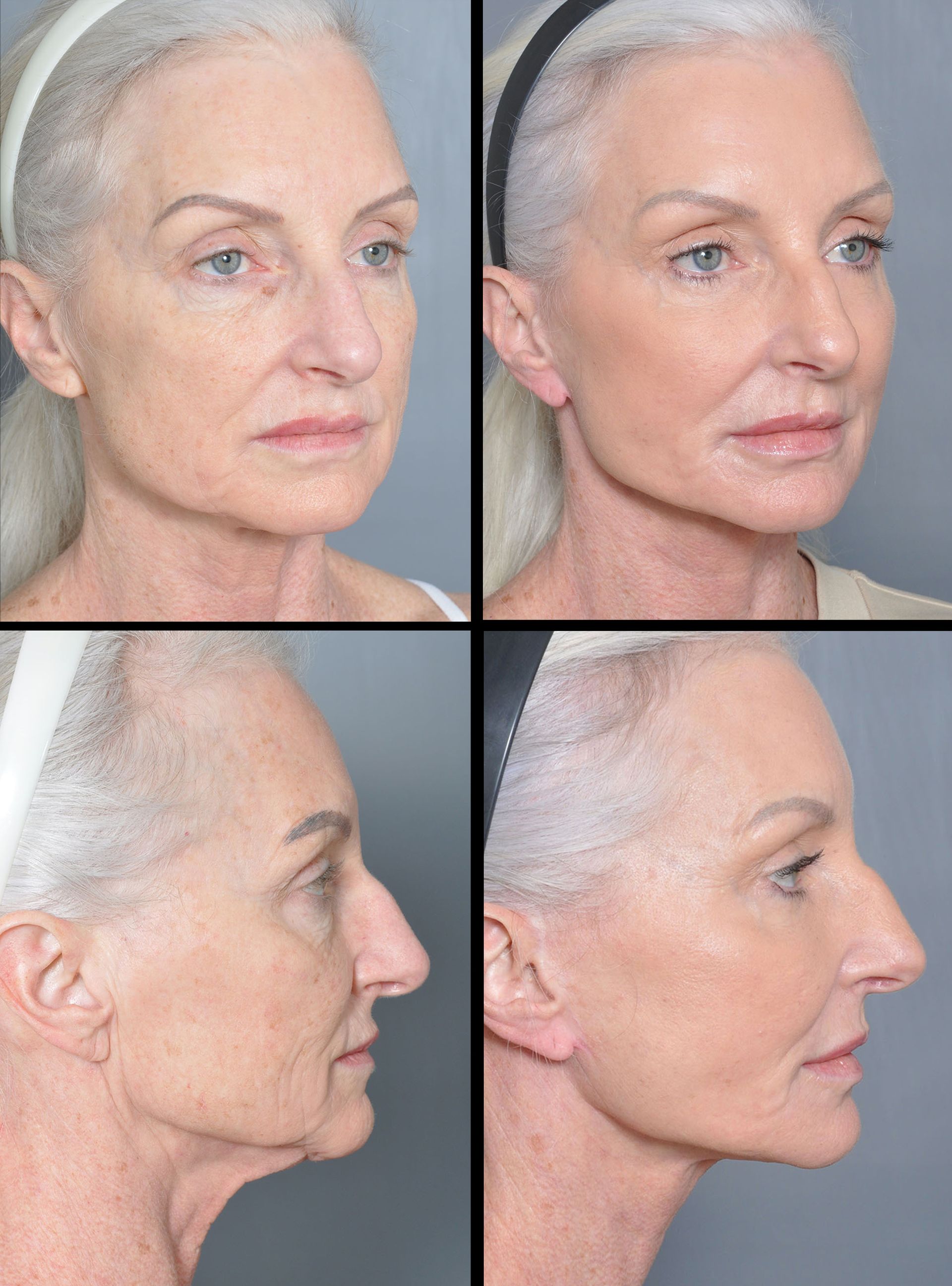 before and after facelift in baton rouge 