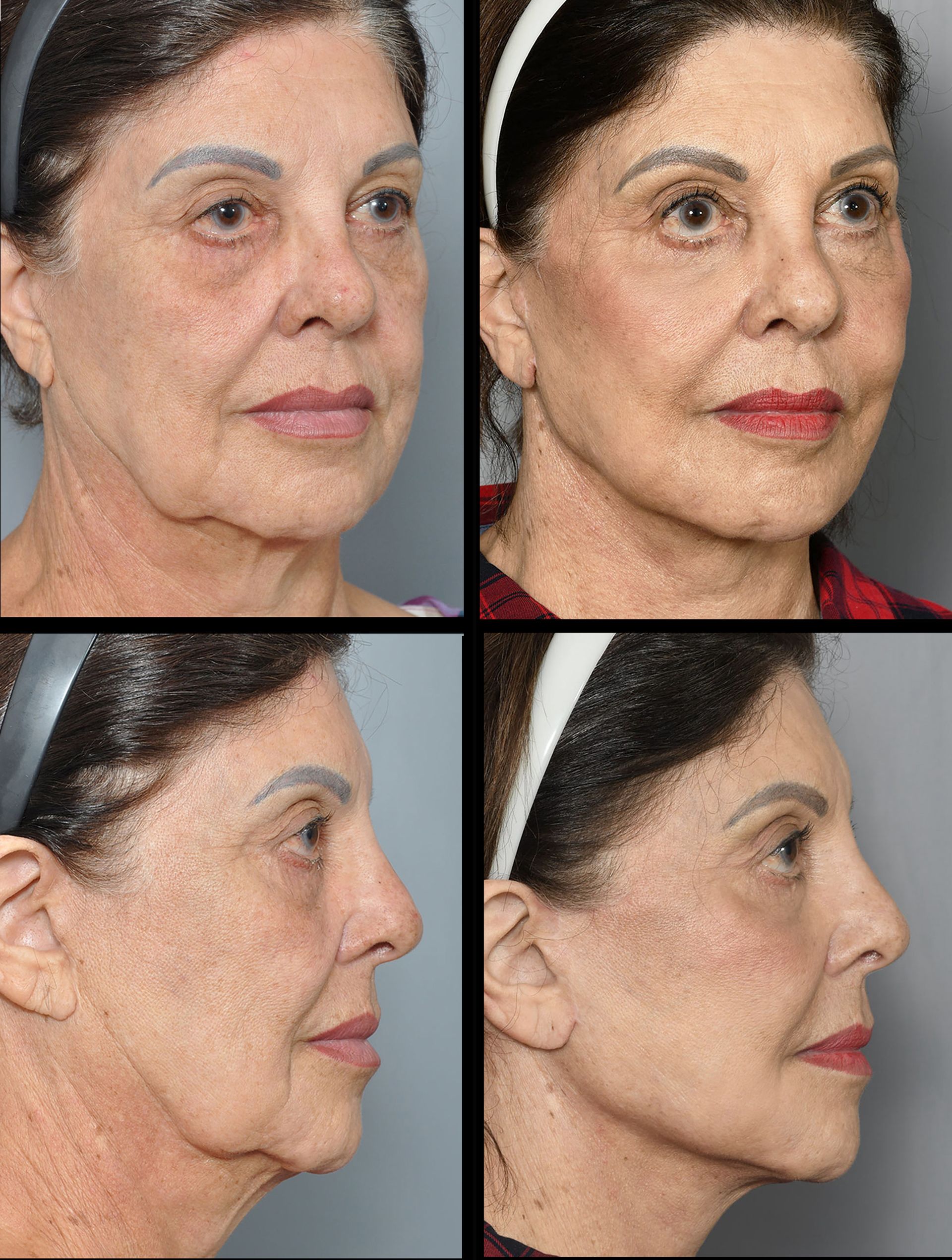 before and after facelift in baton rouge