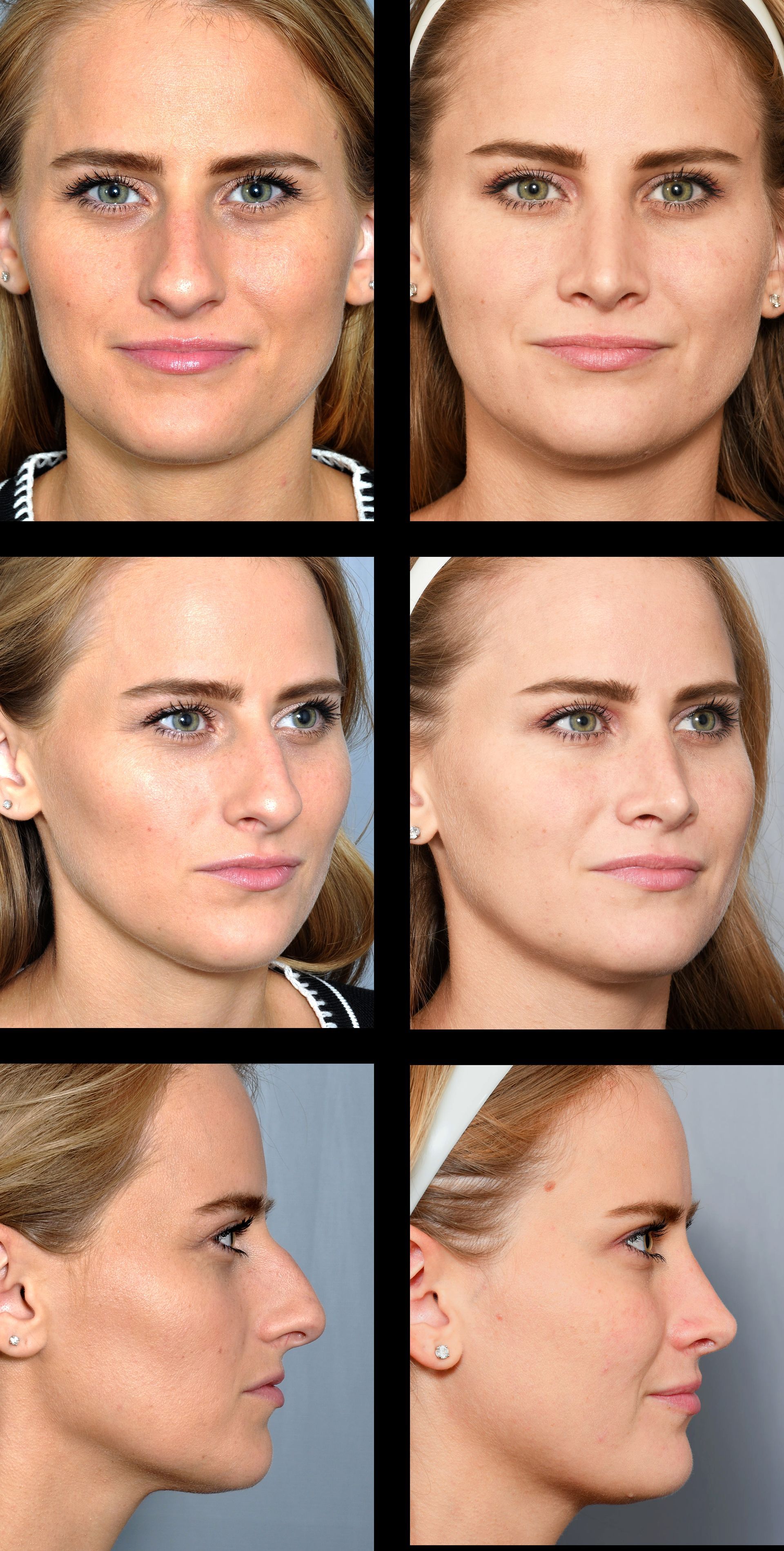 before and after rhinoplasty in baton rouge 