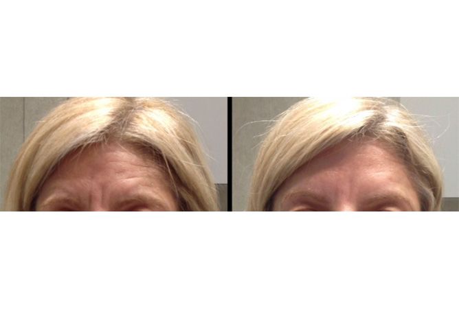 Before and after forehead wrinkle treatment. Wrinkles reduced on the right. Blonde hair, neutral expression.
