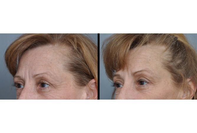 Before and after view of a person with thinning hair, showcasing hair growth after a procedure.
