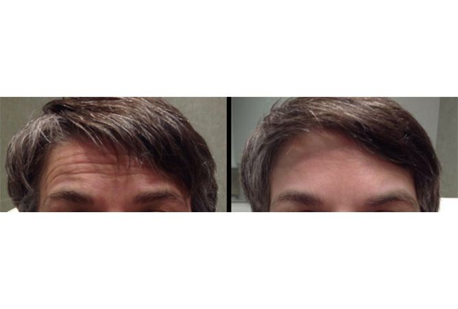 Before and after comparison of a person's forehead, showing a reduction in wrinkles.