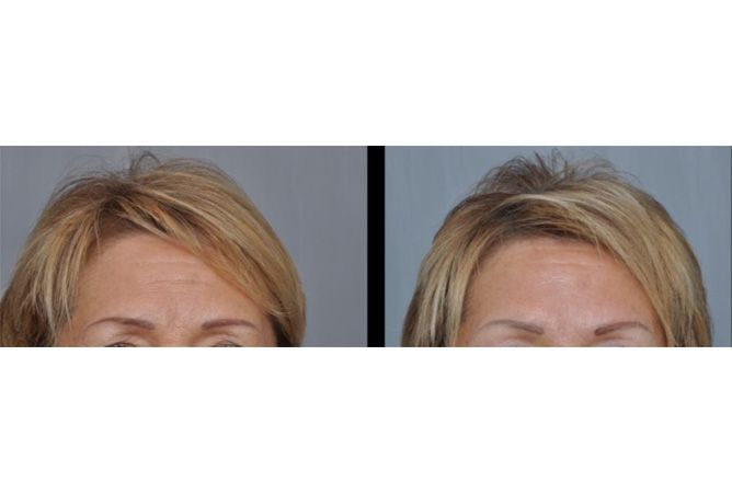 Before and after of a woman's forehead, showing wrinkle reduction.