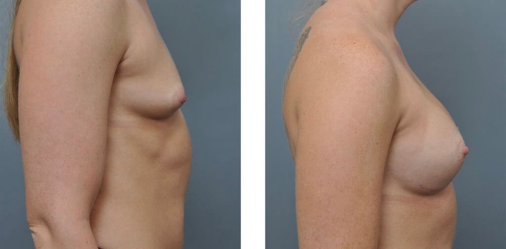 Two side-by-side images show a woman's breast before and after breast augmentation surgery.