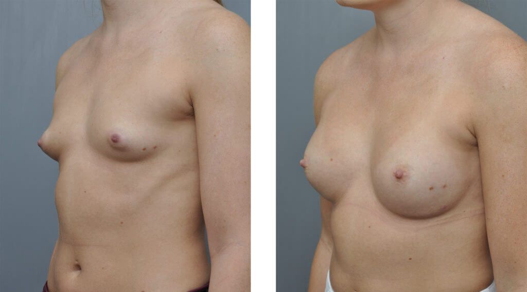 Before and after view of a woman's breasts, showing an increase in size and fullness.