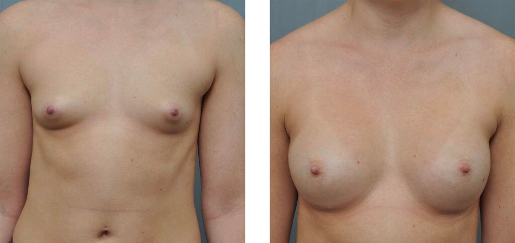 Before and after breast augmentation.