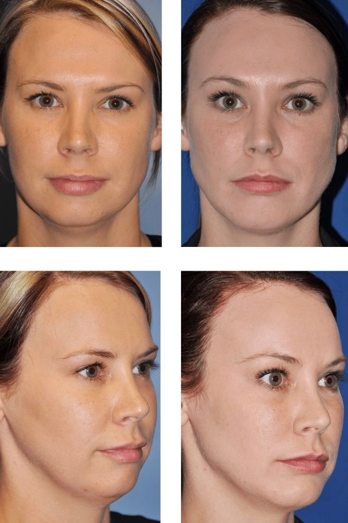 Before and after frontal and profile views of a woman's face, possibly showing cosmetic surgery results.