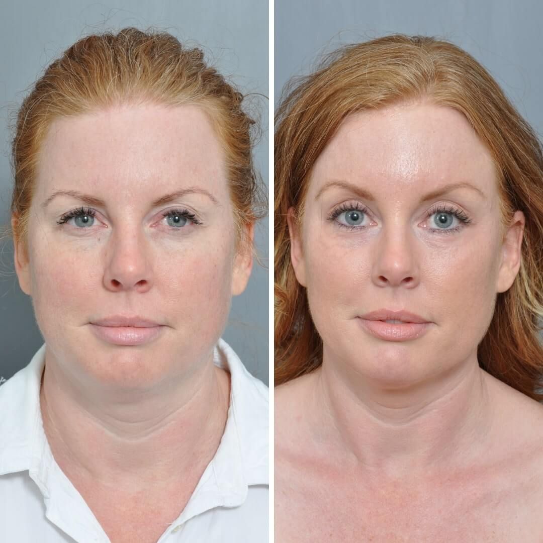 Williamson Cosmetic Center - brow lift gallery