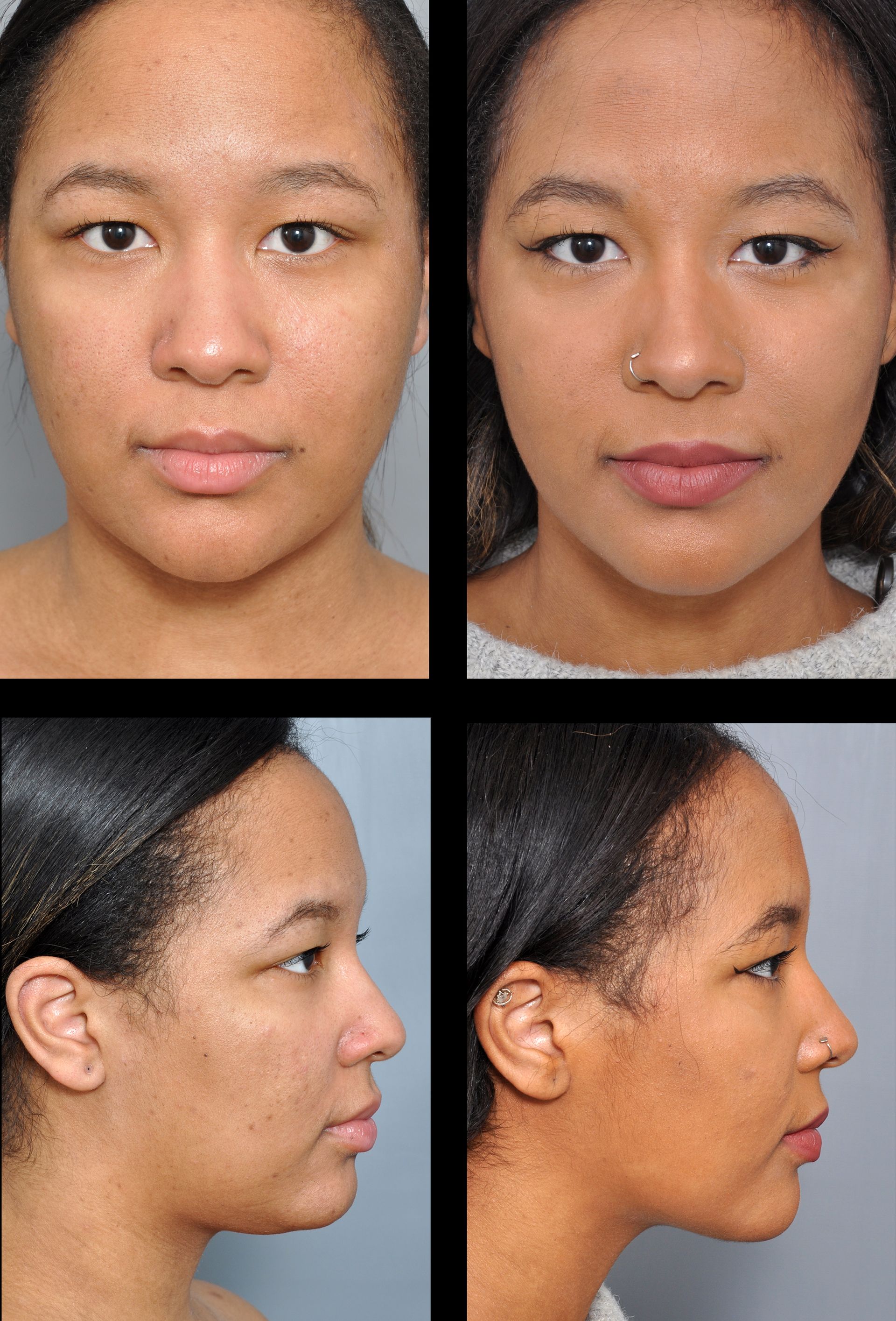 Why You Should Consider Facial Liposuction: Creating Definition Without Looking Overdone