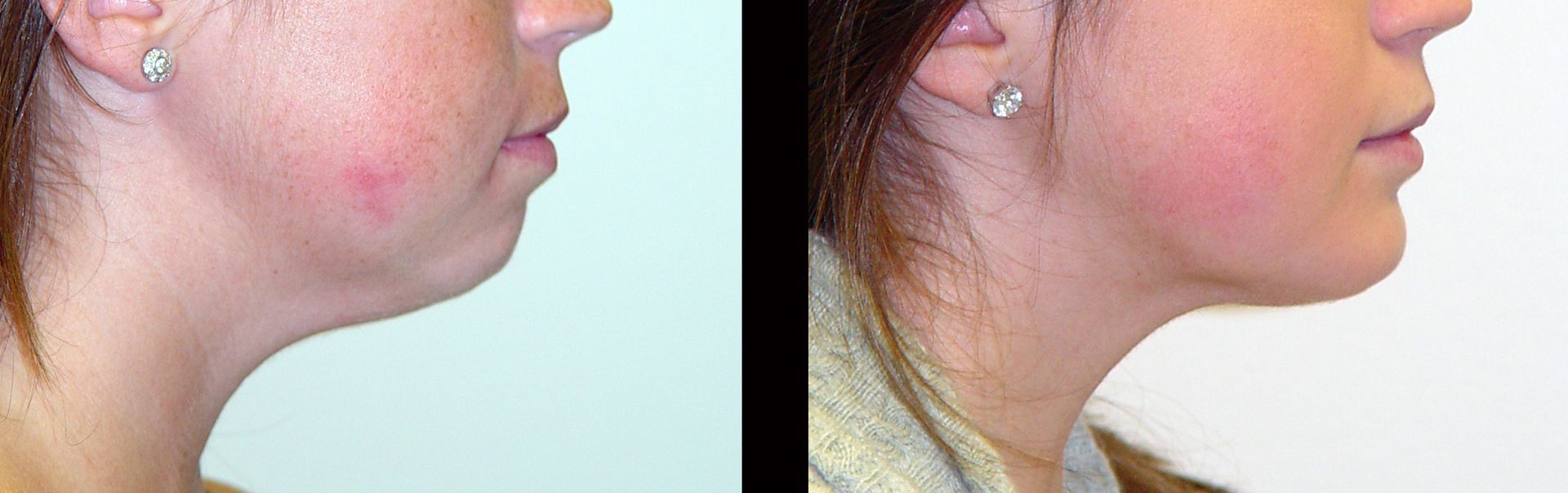 before and after facial liposuction