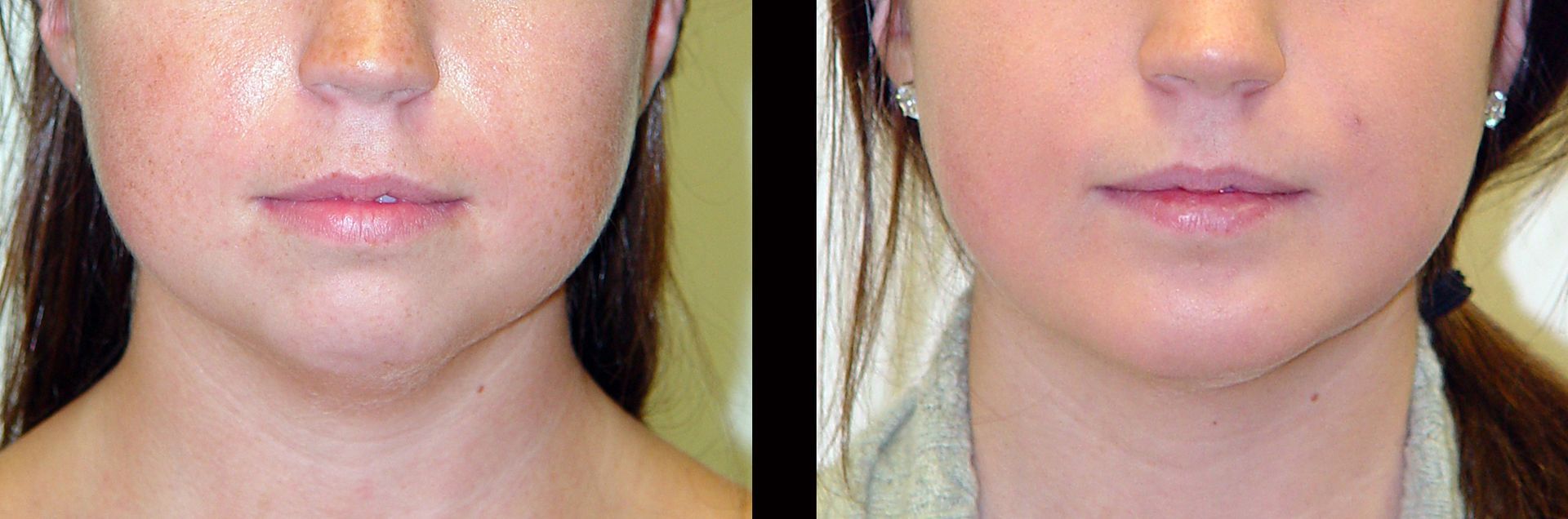 facial liposuction before and after