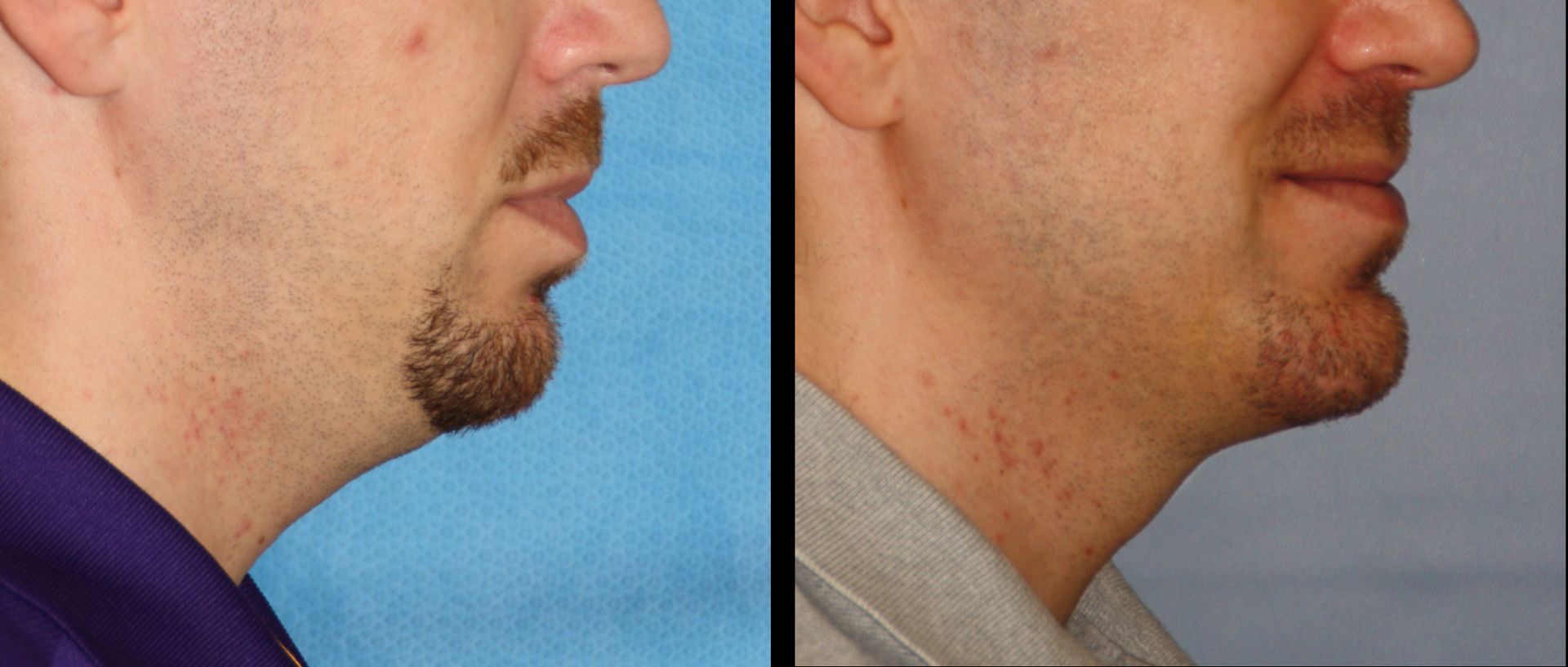 facial liposuction before and after 