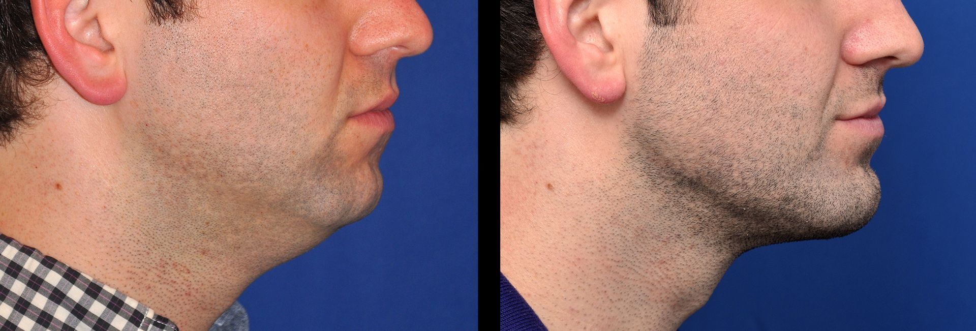 before and after chin implant 