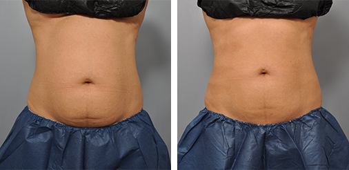 Comparison of a torso before and after a procedure. The abdomen appears less full in the 