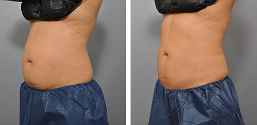 Side-by-side view of a person's abdomen. The left side shows a rounder stomach and the right is flatter.
