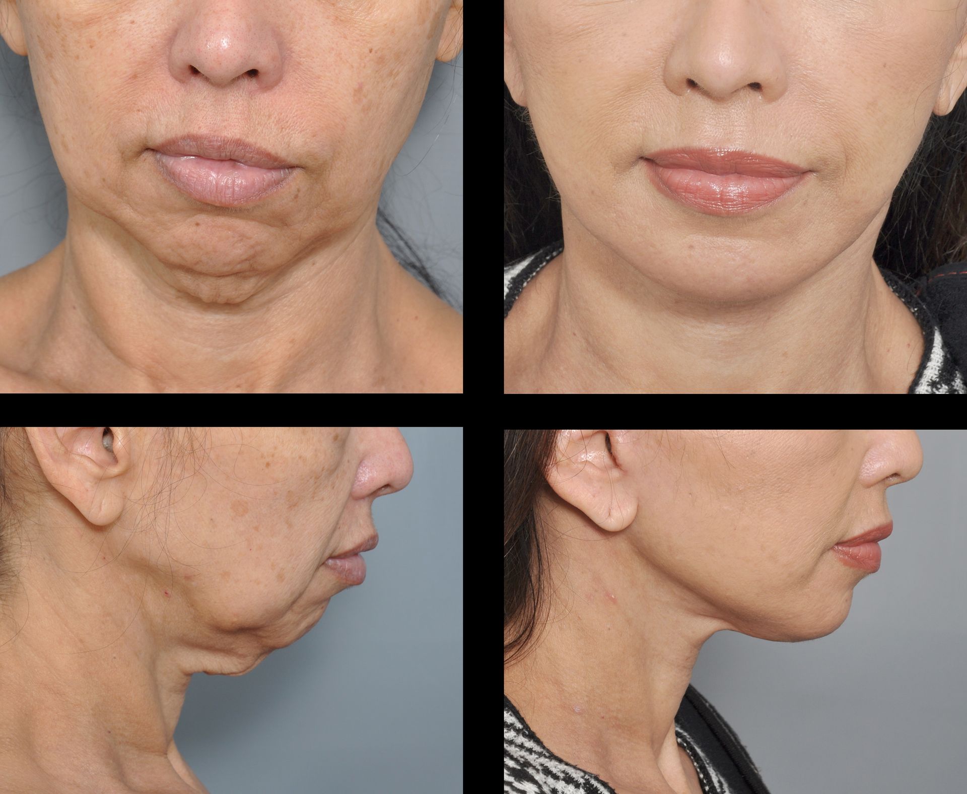 before and after deep plane facelift in baton rouge