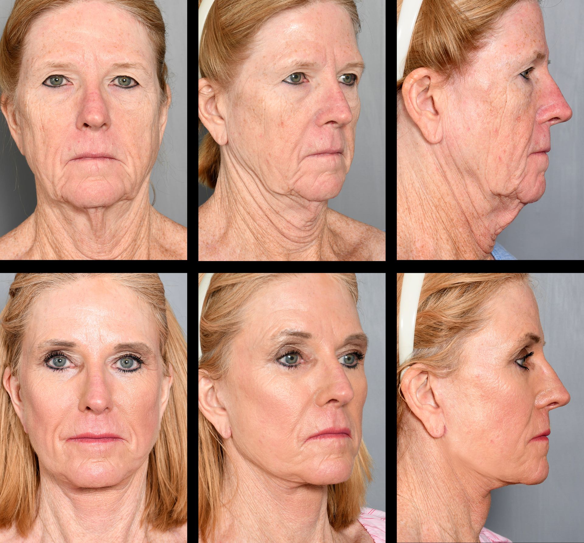 Before and after photos showing a neck lift. The after photo shows a tighter, smoother neck.