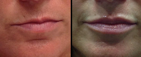 Two close-up photos of lips; before and after a cosmetic procedure, with lips appearing fuller in the after photo.