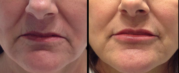 Side-by-side comparison of a person's lower face. Left side: Before. Right side: After. Lips look fuller, lines reduced.