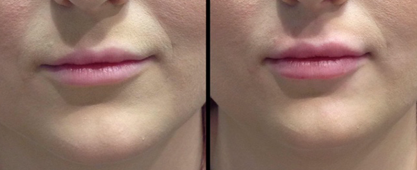 Two close-up photos side-by-side of the same person's lips, before and after a procedure.