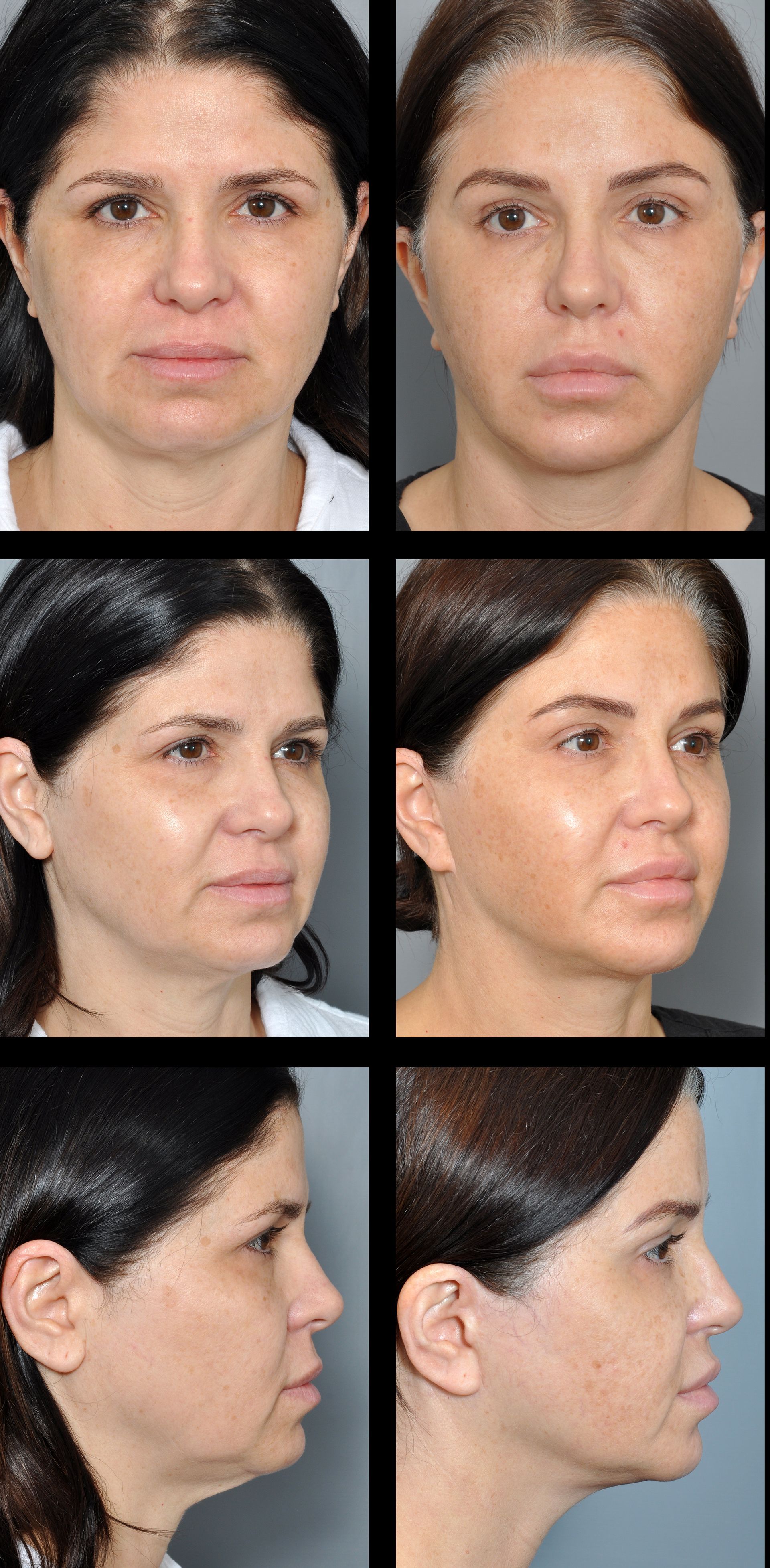 before and after brow lift and facelift 