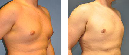 Comparison of a male chest before and after a medical procedure.