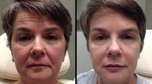 Side-by-side comparison of a person's face. Left shows wrinkles and redness; right shows smoother skin.