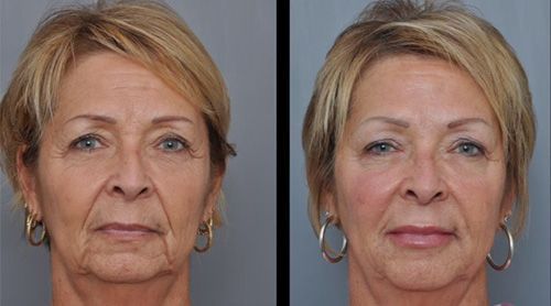 Before and after photos showing a person's face with noticeable wrinkle reduction after a procedure.