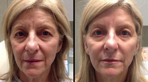 Side-by-side comparison of a person's face. Left side: older appearance. Right side: smoother skin with diminished wrinkles.