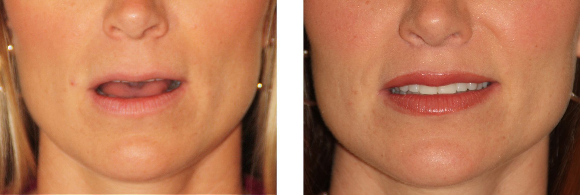 A woman's face, showing symptoms of facial paralysis (drooping mouth), then after treatment.
